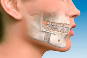 Cirugia Maxilo Facial 