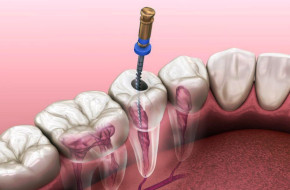 Endodoncia