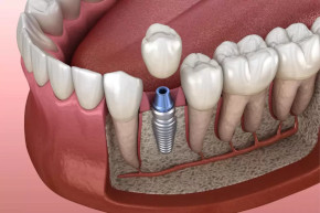 Impantes Dentales 