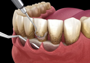 Periodoncia 